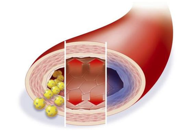 低密度膽固醇超標，多久會影響血管健康？來看看鹽城康復醫(yī)院醫(yī)生怎么說